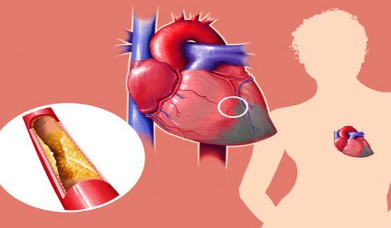 What are the risks associated with Coronary Artery Bypass Grafting?